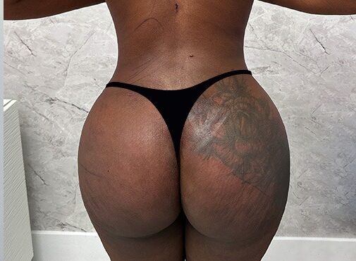 Body Enhancement (Boobs & Bum Extensions)